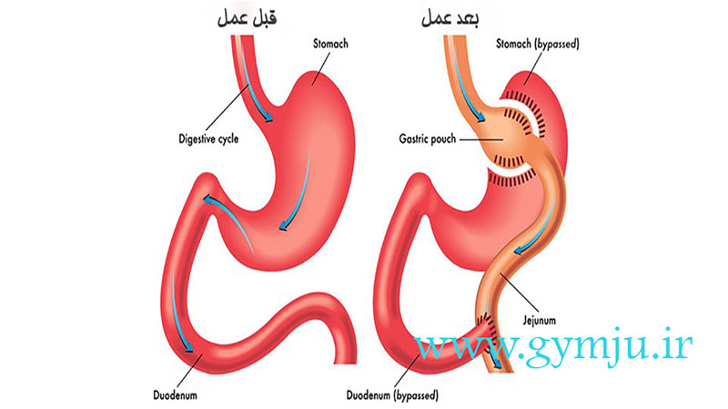 عمل بای پس معده