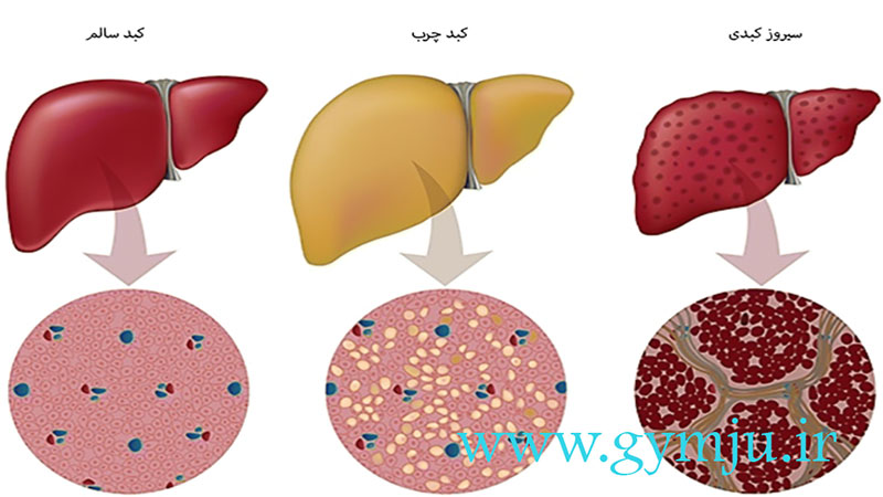 کبد چرب