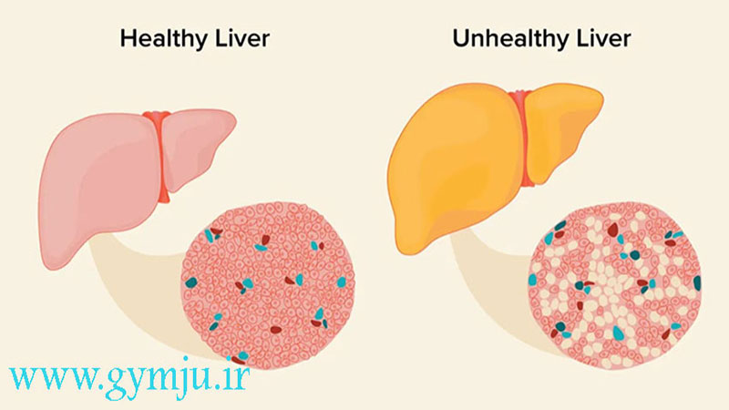 درمان چربی کبد