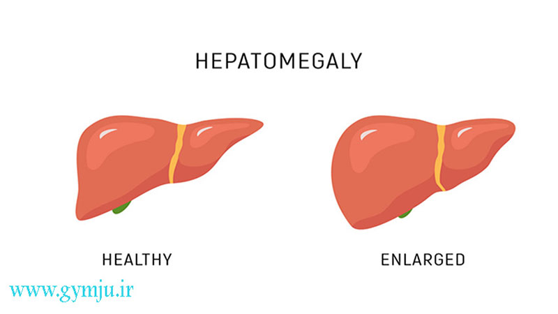 هپاتومگالی چیست؟