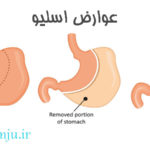 عوارض اسلیو
