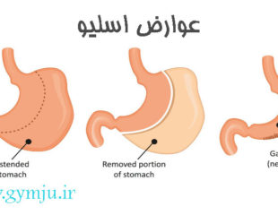 عوارض اسلیو