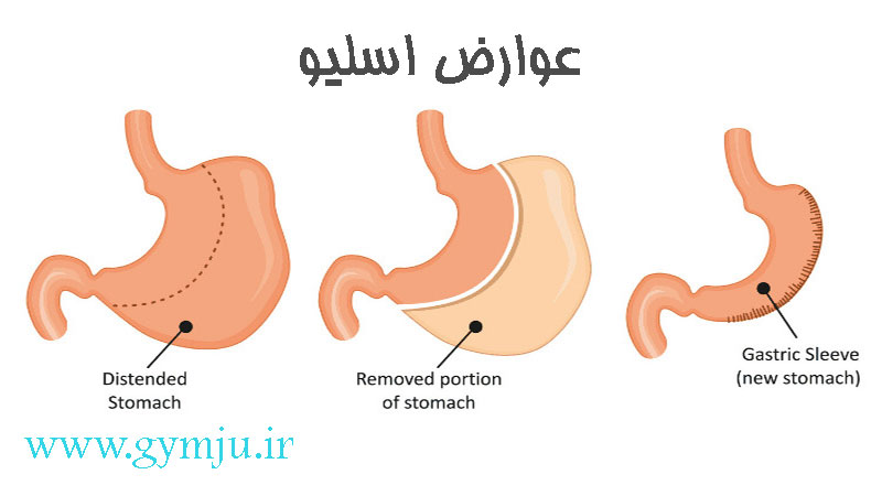 عوارض اسلیو