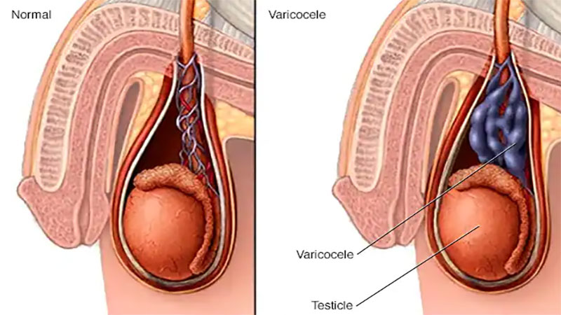 واریکوسل