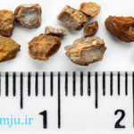 اندازه سنگ کلیه