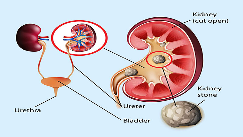 سنگ کلیه چیست
