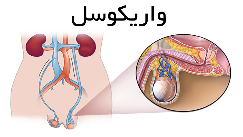 واریس بیضه