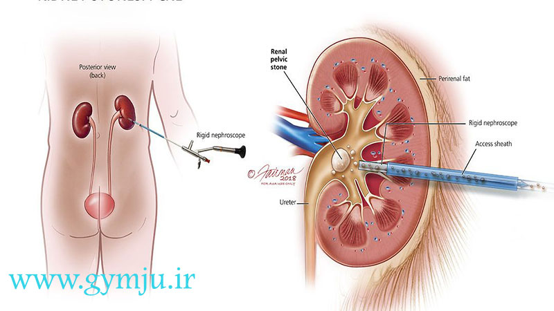 دفع سنگ کلیه با لاپاراسکوپ