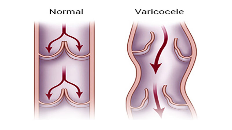 عوارض واریکوسل