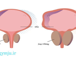 سرطان پروستات