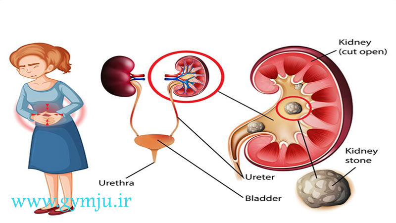 درد سنگ کلیه