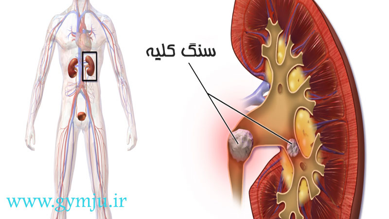 جراحی باز سنگ کلیه