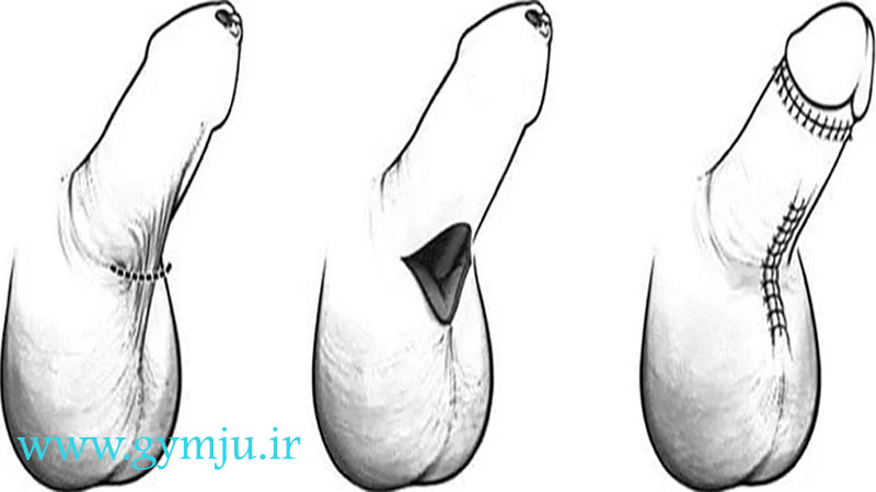 آلت تناسلی پرده دار