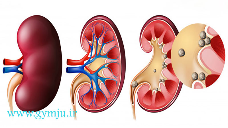 سنگ کلیه چیست