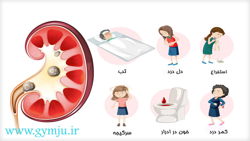 علائم سنگ کلیه