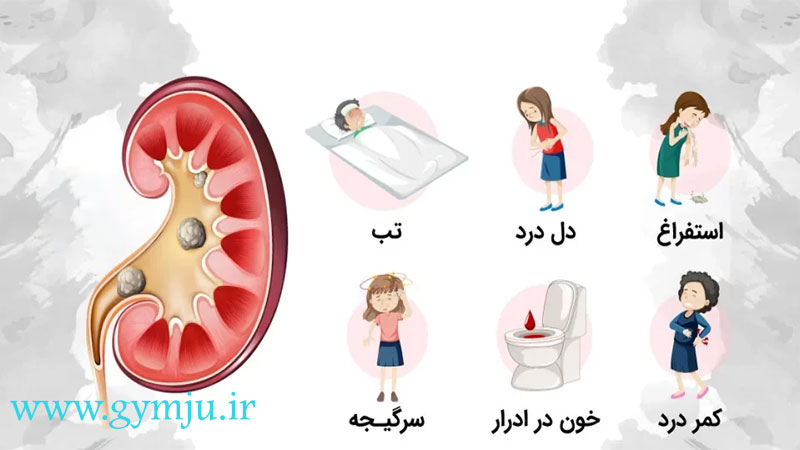 علائم سنگ کلیه