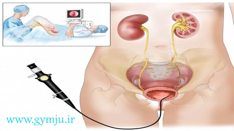 شکستن و خارج کردن سنگ کلیه