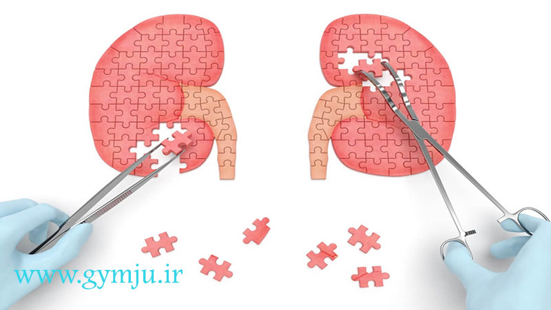جراحی برای درمان قطعی سنگ کلیه