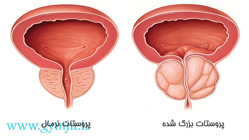 سرطان پروستات
