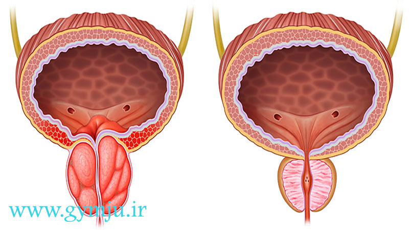 اختلالات پروستات