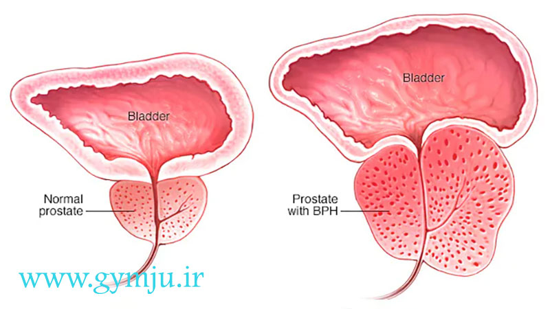علت بزرگ شدن خوش خیم پروستات
