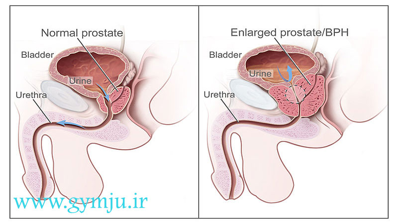 مشکلات جنسی از علائم پروستات