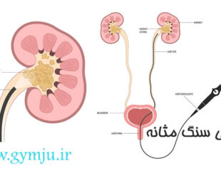 جراحی سنگ مثانه