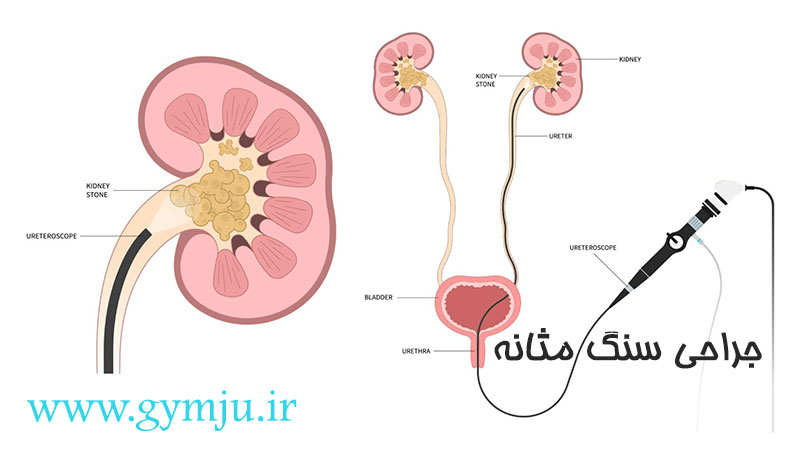 جراحی سنگ مثانه