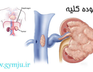 توده کلیه