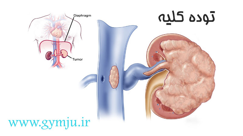 توده کلیه