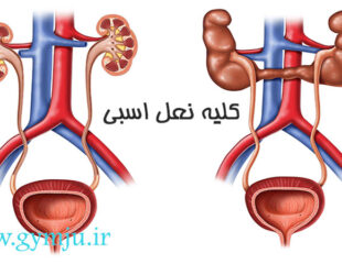 کلیه نعل اسبی