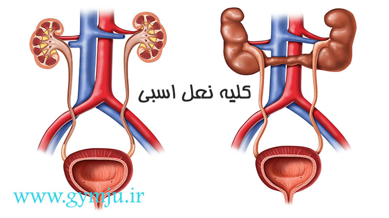 کلیه نعل اسبی