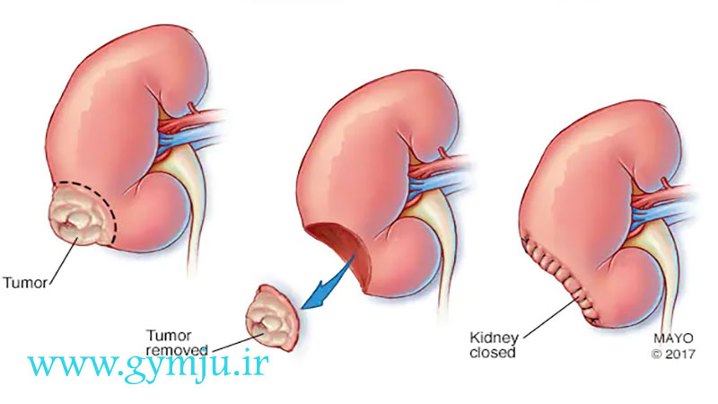 درمان تومورهای کلیه