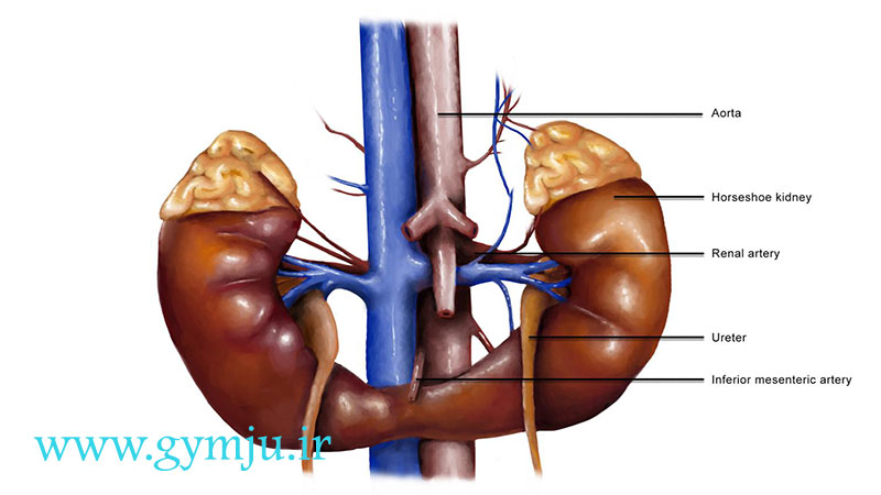 عوارض کلیه نعل اسبی