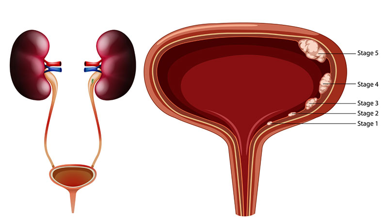 انواع سرطان مثانه